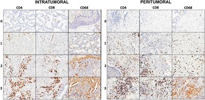 Combined Immunoscore for Prognostic Stratification of Early Stage Non-Small-Cell Lung Cancer
